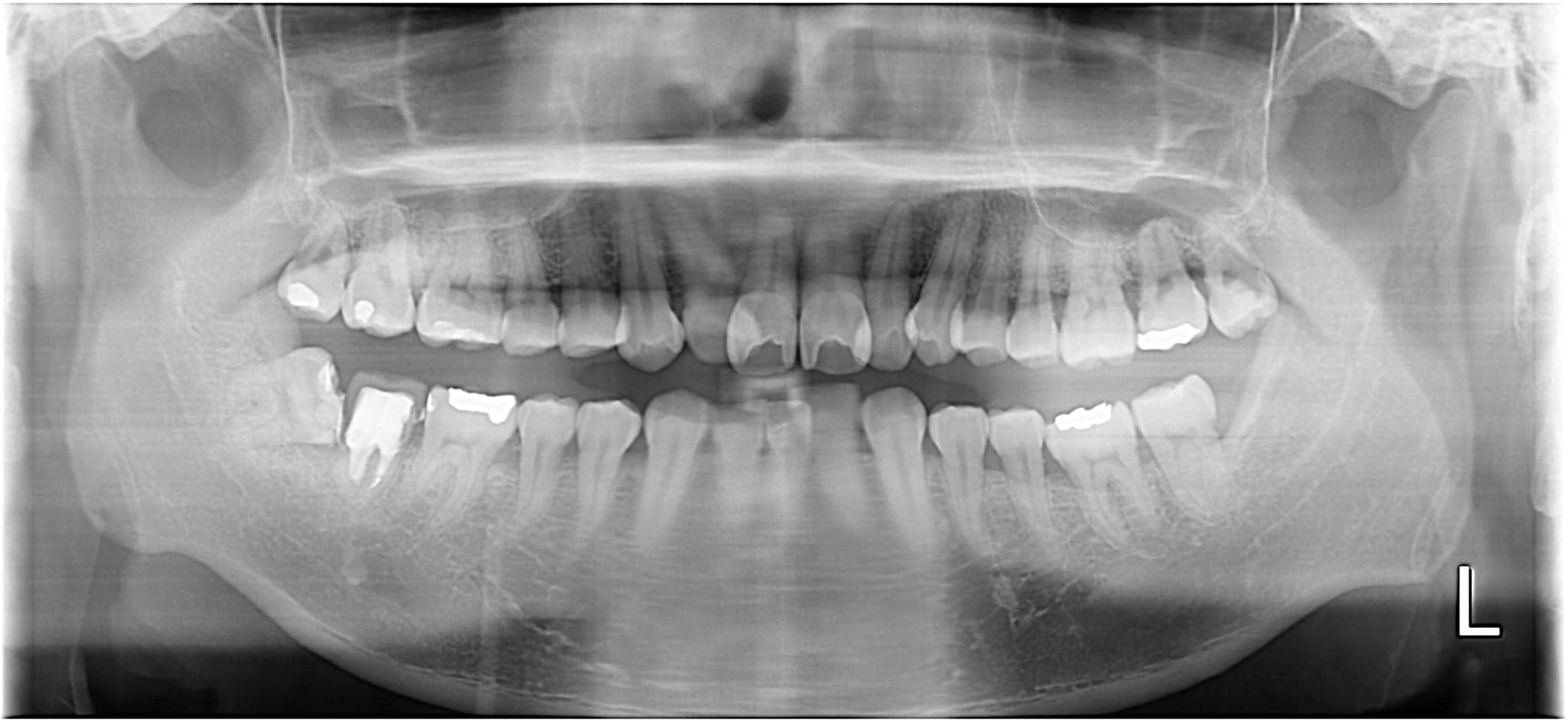 30代 男性 親知らず抜歯 症例